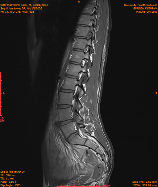 2026-04-15/Entire Spine/Sag t1 tse lower DR/0015-IM226.png
