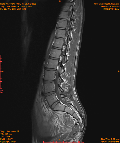 2026-04-15/Entire Spine/Sag t1 tse lower DR/0016-IM227.png