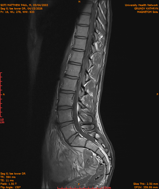 2026-04-15/Entire Spine/Sag t1 tse lower DR/0017-IM228.png