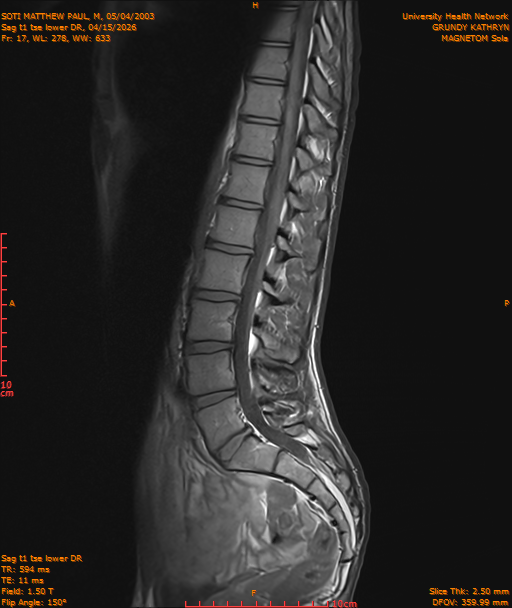 2026-04-15/Entire Spine/Sag t1 tse lower DR/0018-IM229.png
