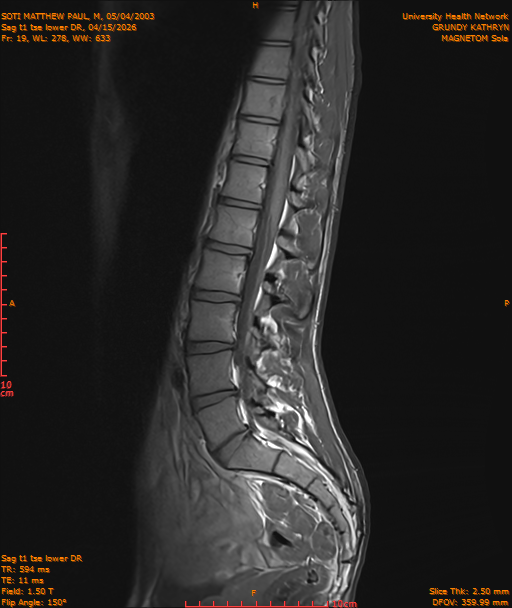 2026-04-15/Entire Spine/Sag t1 tse lower DR/0020-IM231.png