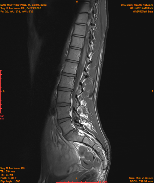 2026-04-15/Entire Spine/Sag t1 tse lower DR/0021-IM232.png