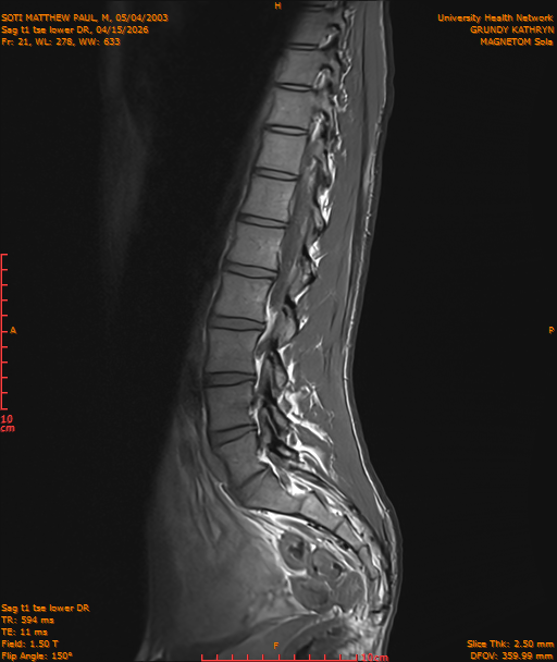 2026-04-15/Entire Spine/Sag t1 tse lower DR/0022-IM233.png