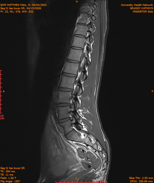 2026-04-15/Entire Spine/Sag t1 tse lower DR/0023-IM234.png