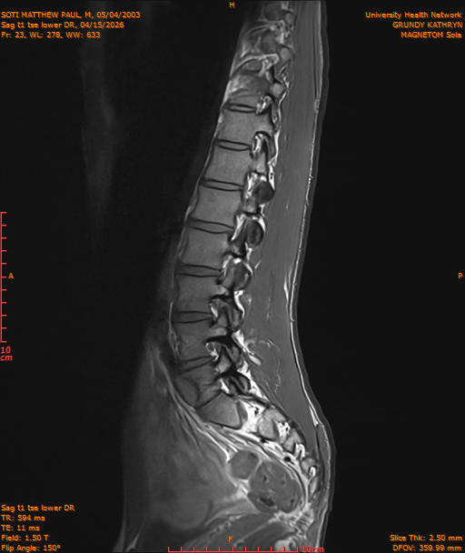 2026-04-15/Entire Spine/Sag t1 tse lower DR/0024-IM235.png