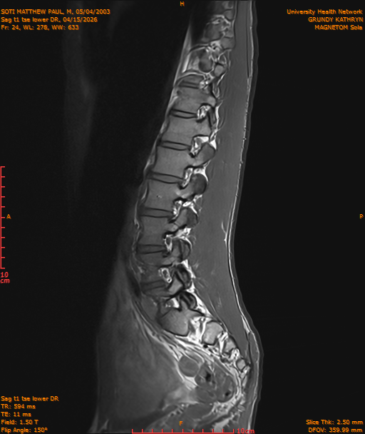 2026-04-15/Entire Spine/Sag t1 tse lower DR/0025-IM236.png