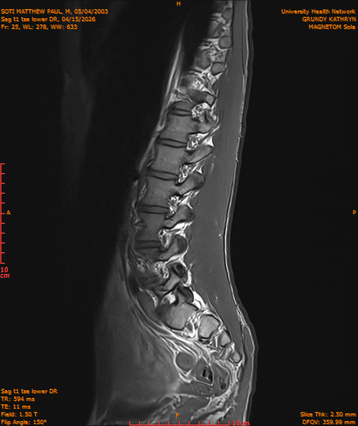 2026-04-15/Entire Spine/Sag t1 tse lower DR/0026-IM237.png