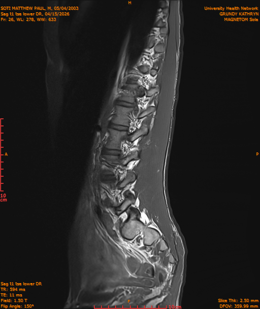 2026-04-15/Entire Spine/Sag t1 tse lower DR/0027-IM238.png