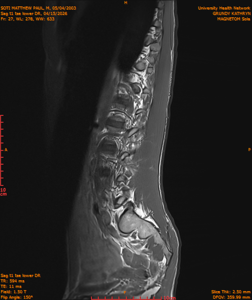 2026-04-15/Entire Spine/Sag t1 tse lower DR/0028-IM239.png