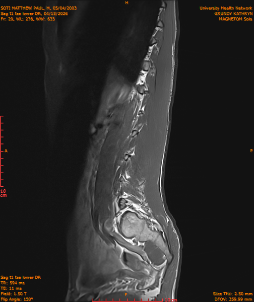 2026-04-15/Entire Spine/Sag t1 tse lower DR/0030-IM241.png