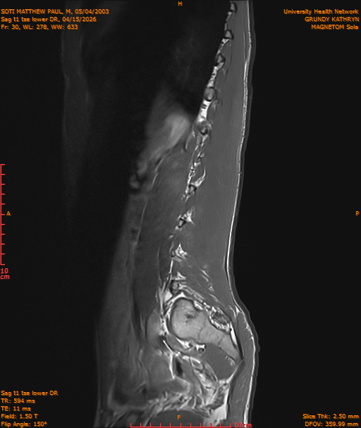 2026-04-15/Entire Spine/Sag t1 tse lower DR/0031-IM242.png