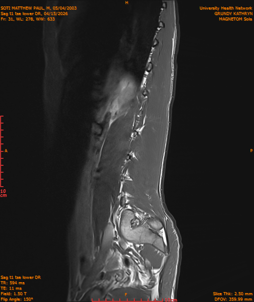 2026-04-15/Entire Spine/Sag t1 tse lower DR/0032-IM243.png
