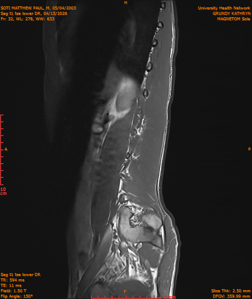 2026-04-15/Entire Spine/Sag t1 tse lower DR/0033-IM244.png