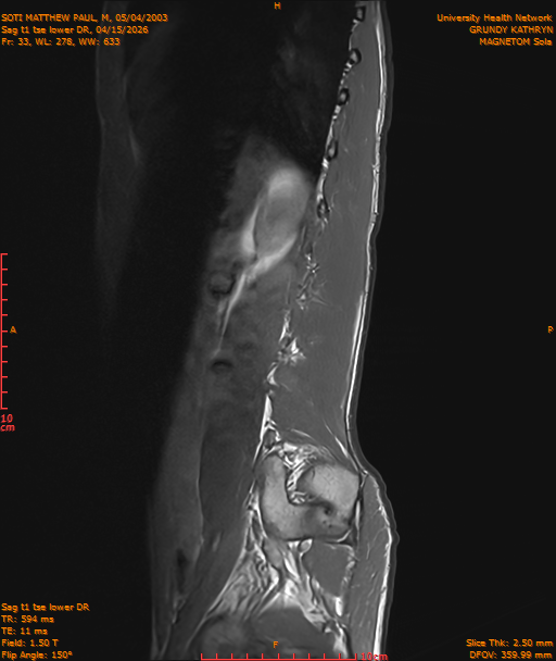 2026-04-15/Entire Spine/Sag t1 tse lower DR/0034-IM245.png