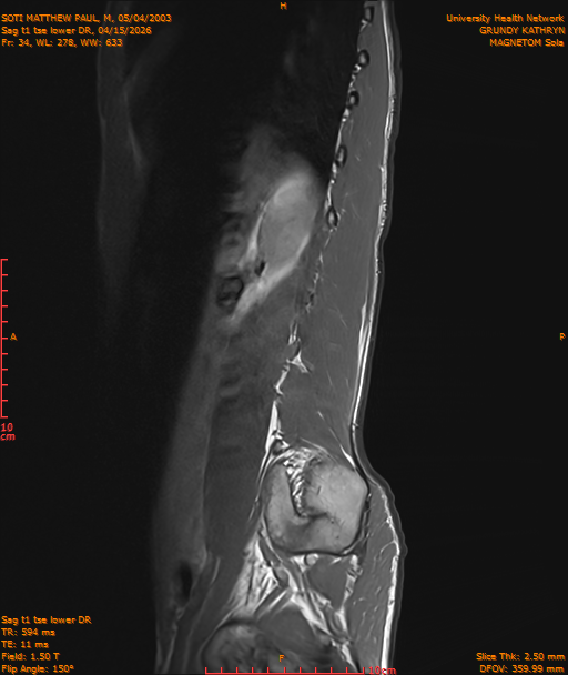 2026-04-15/Entire Spine/Sag t1 tse lower DR/0035-IM246.png