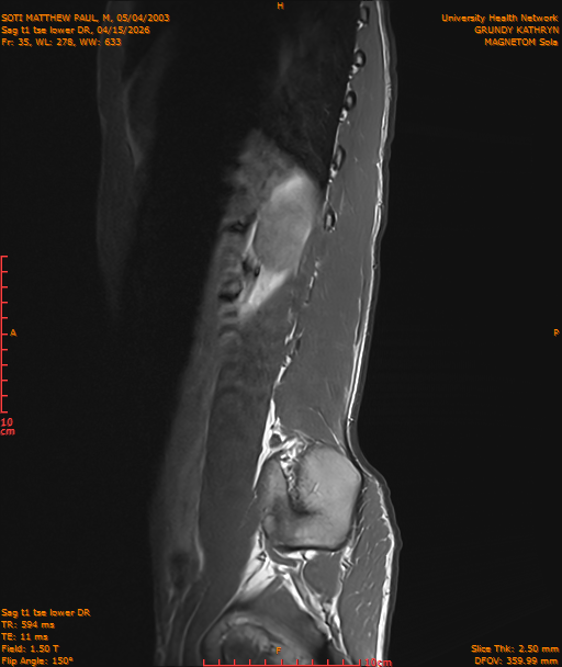2026-04-15/Entire Spine/Sag t1 tse lower DR/0036-IM247.png