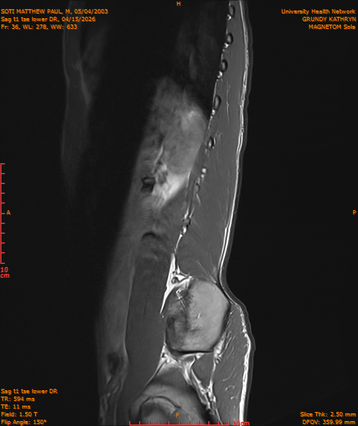 2026-04-15/Entire Spine/Sag t1 tse lower DR/0037-IM248.png