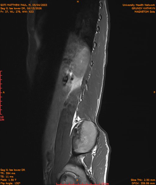 2026-04-15/Entire Spine/Sag t1 tse lower DR/0038-IM249.png