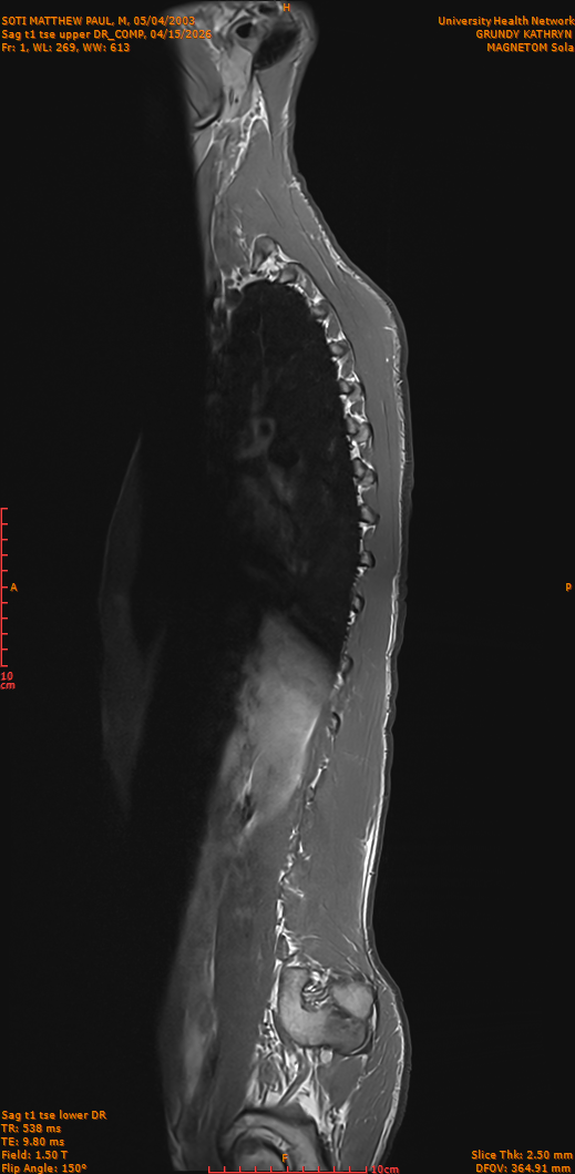 2026-04-15/Entire Spine/Sag t1 tse upper DR_COMP/0002-IM251.png