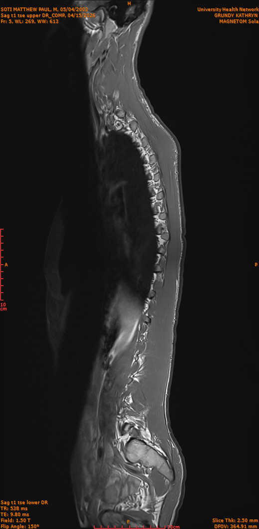 2026-04-15/Entire Spine/Sag t1 tse upper DR_COMP/0006-IM255.png