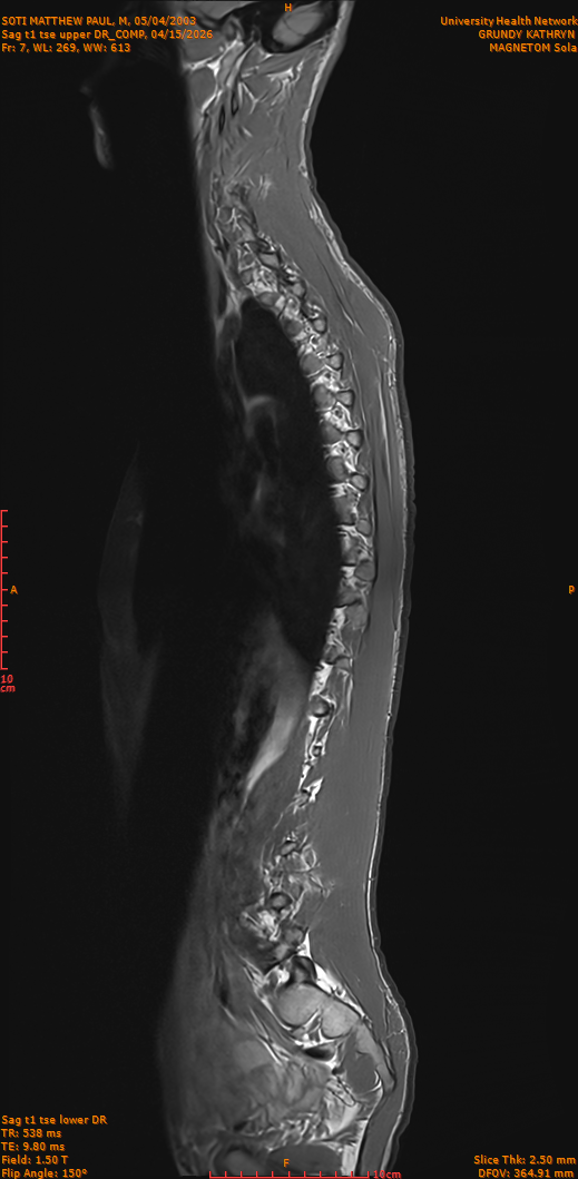 2026-04-15/Entire Spine/Sag t1 tse upper DR_COMP/0008-IM257.png