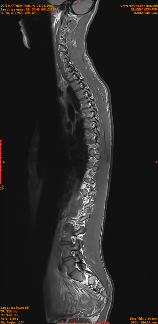 2026-04-15/Entire Spine/Sag t1 tse upper DR_COMP/0011-IM260.png