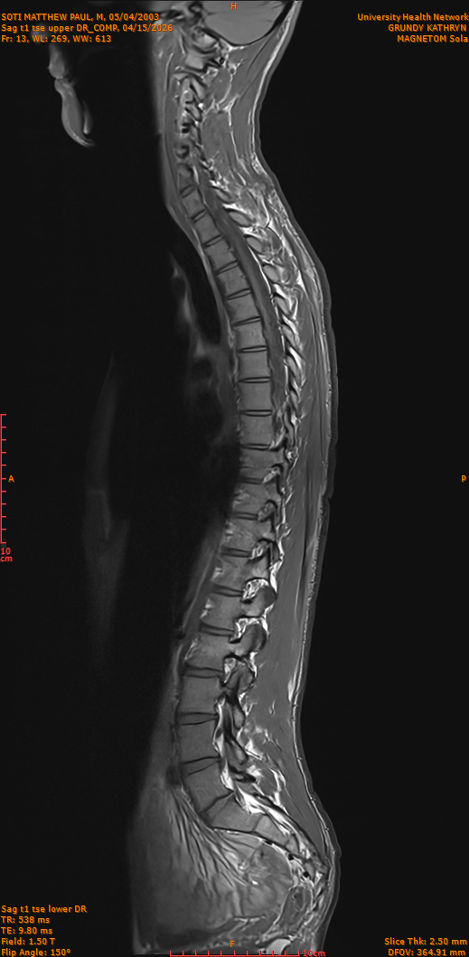 2026-04-15/Entire Spine/Sag t1 tse upper DR_COMP/0014-IM263.png