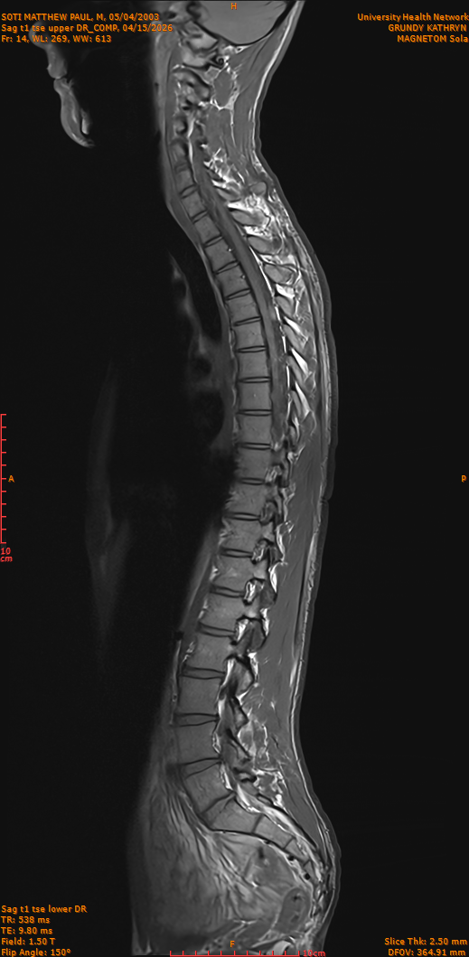 2026-04-15/Entire Spine/Sag t1 tse upper DR_COMP/0015-IM264.png