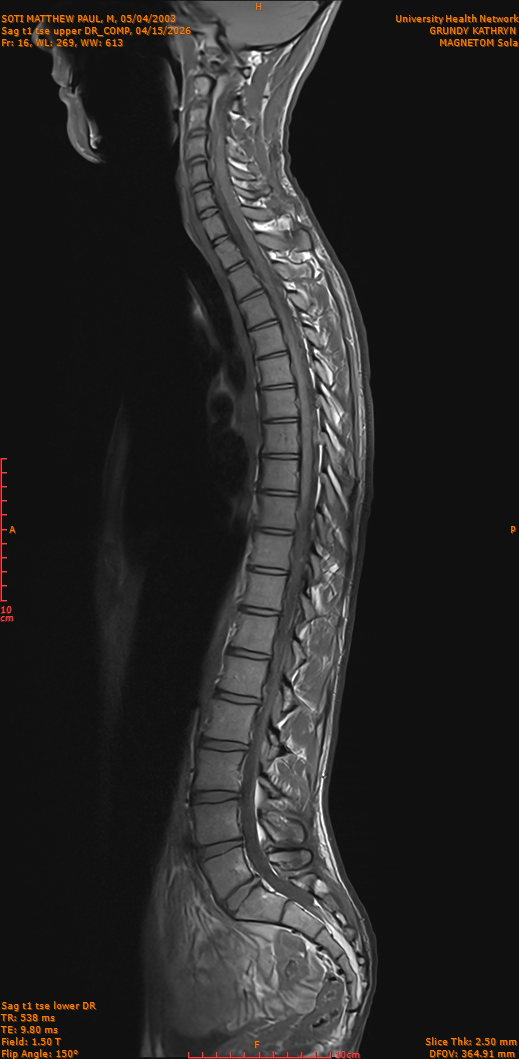 2026-04-15/Entire Spine/Sag t1 tse upper DR_COMP/0017-IM266.png