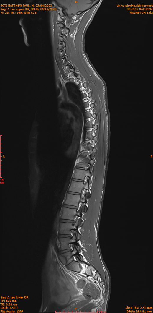 2026-04-15/Entire Spine/Sag t1 tse upper DR_COMP/0024-IM273.png