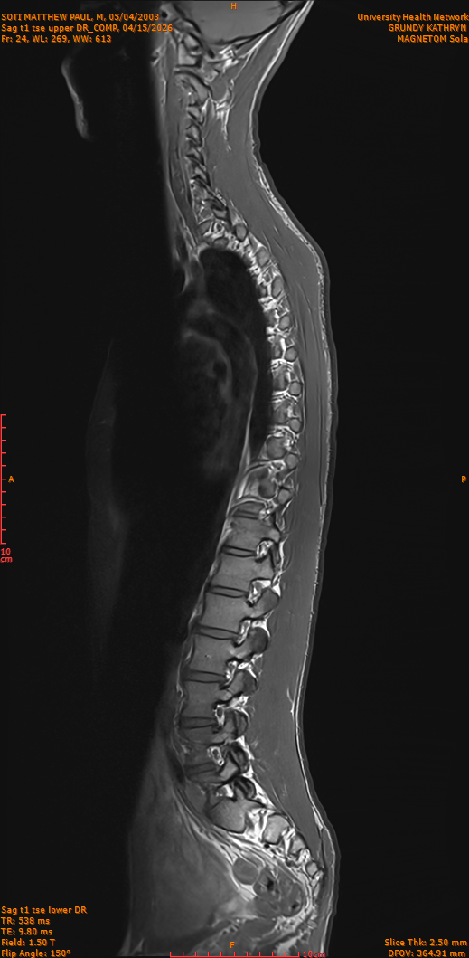 2026-04-15/Entire Spine/Sag t1 tse upper DR_COMP/0025-IM274.png