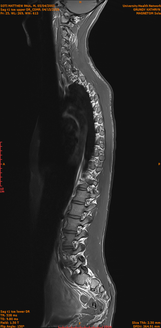 2026-04-15/Entire Spine/Sag t1 tse upper DR_COMP/0026-IM275.png