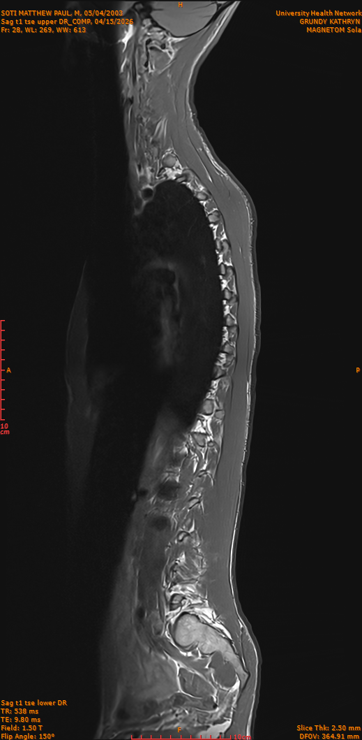2026-04-15/Entire Spine/Sag t1 tse upper DR_COMP/0029-IM278.png