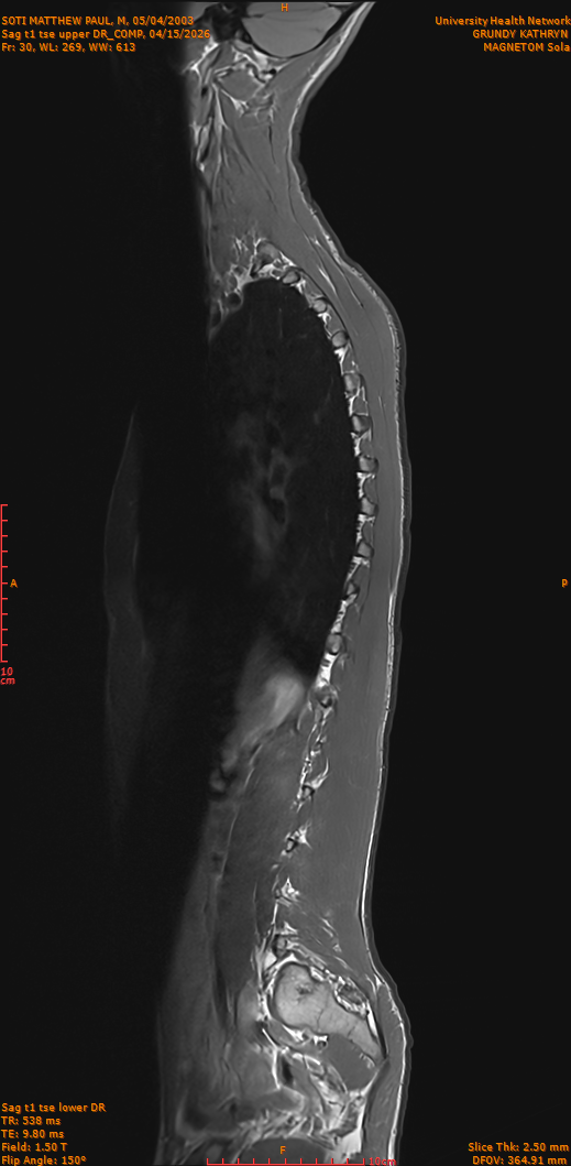 2026-04-15/Entire Spine/Sag t1 tse upper DR_COMP/0031-IM280.png