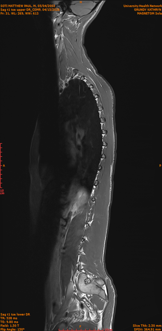 2026-04-15/Entire Spine/Sag t1 tse upper DR_COMP/0032-IM281.png