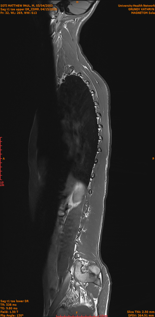 2026-04-15/Entire Spine/Sag t1 tse upper DR_COMP/0033-IM282.png
