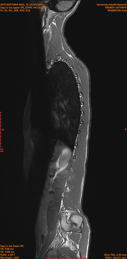 2026-04-15/Entire Spine/Sag t1 tse upper DR_COMP/0034-IM283.png