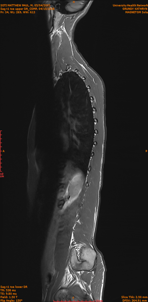2026-04-15/Entire Spine/Sag t1 tse upper DR_COMP/0035-IM284.png