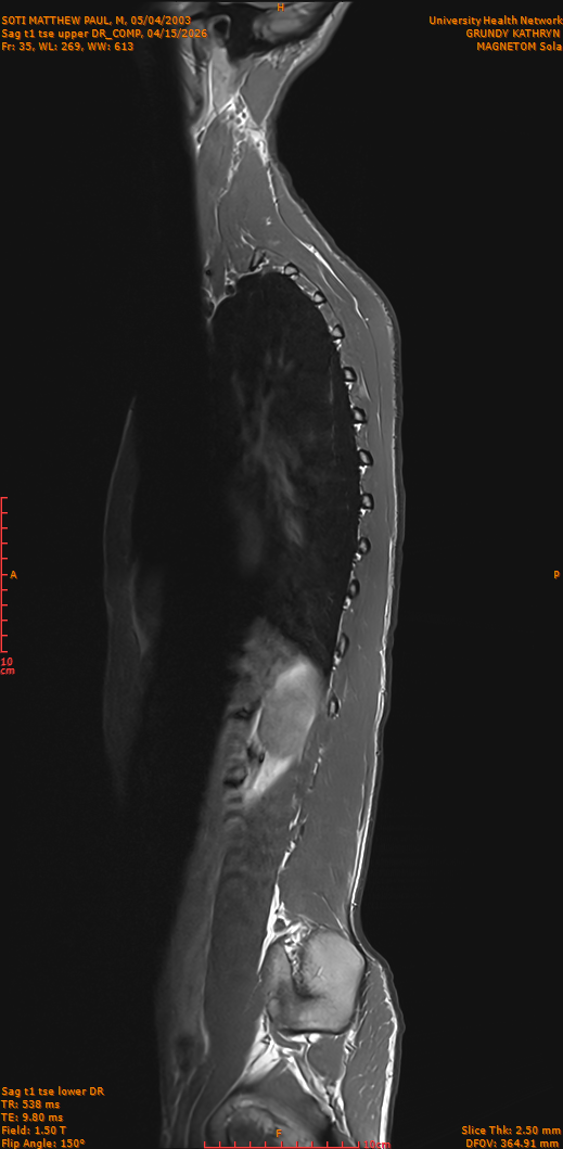 2026-04-15/Entire Spine/Sag t1 tse upper DR_COMP/0036-IM285.png