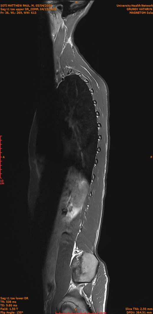 2026-04-15/Entire Spine/Sag t1 tse upper DR_COMP/0037-IM286.png