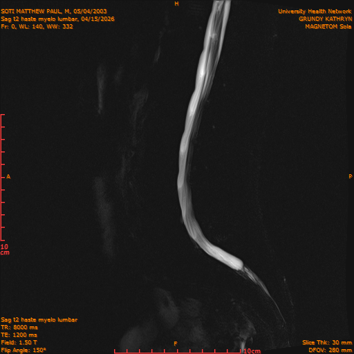 2026-04-15/Entire Spine/Sag t2 haste myelo lumbar/0001-IM147.png