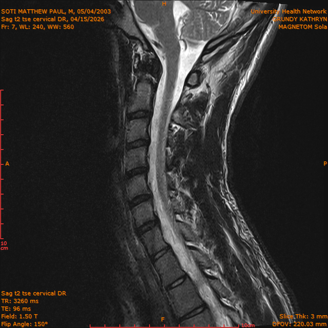 2026-04-15/Entire Spine/Sag t2 tse Cervical DR/0008-IM294.png