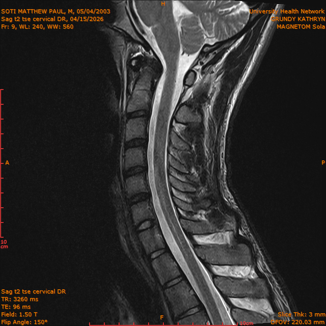 2026-04-15/Entire Spine/Sag t2 tse Cervical DR/0010-IM296.png