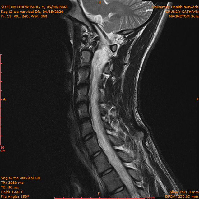 2026-04-15/Entire Spine/Sag t2 tse Cervical DR/0012-IM298.png