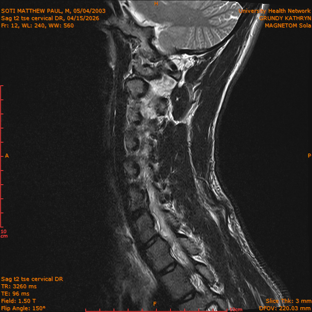 2026-04-15/Entire Spine/Sag t2 tse Cervical DR/0013-IM299.png