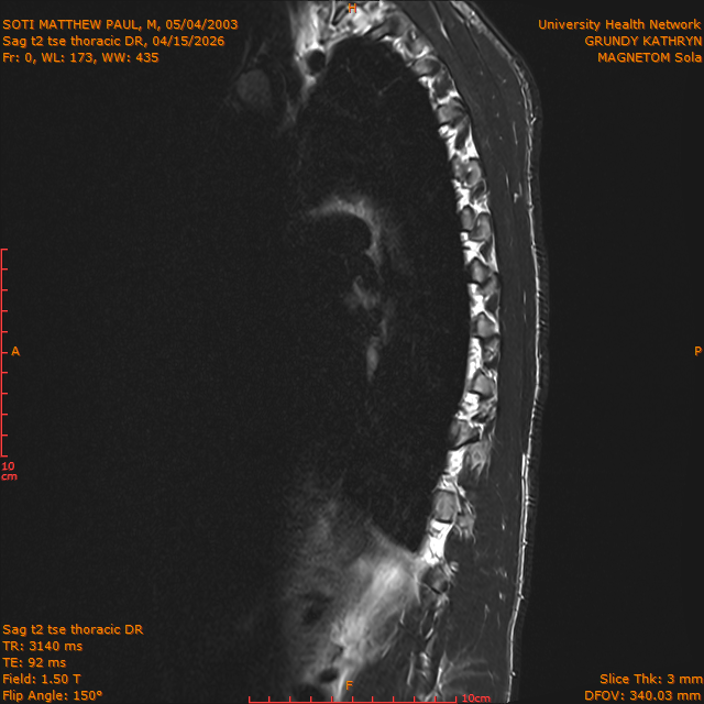 2026-04-15/Entire Spine/Sag t2 tse Thoracic DR/0001-IM304.png