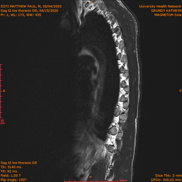 2026-04-15/Entire Spine/Sag t2 tse Thoracic DR/0002-IM305.png