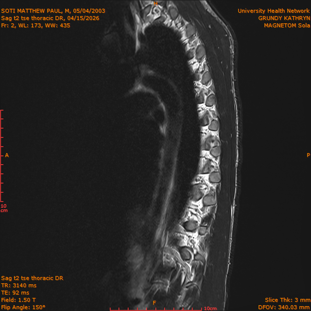 2026-04-15/Entire Spine/Sag t2 tse Thoracic DR/0003-IM306.png