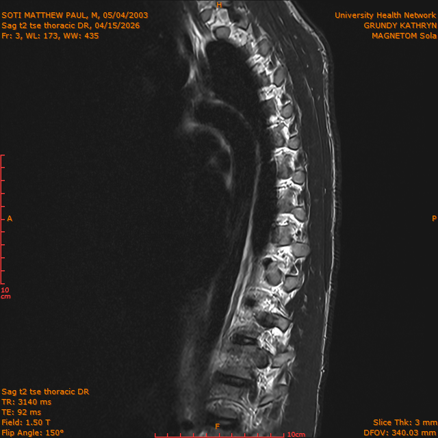2026-04-15/Entire Spine/Sag t2 tse Thoracic DR/0004-IM307.png