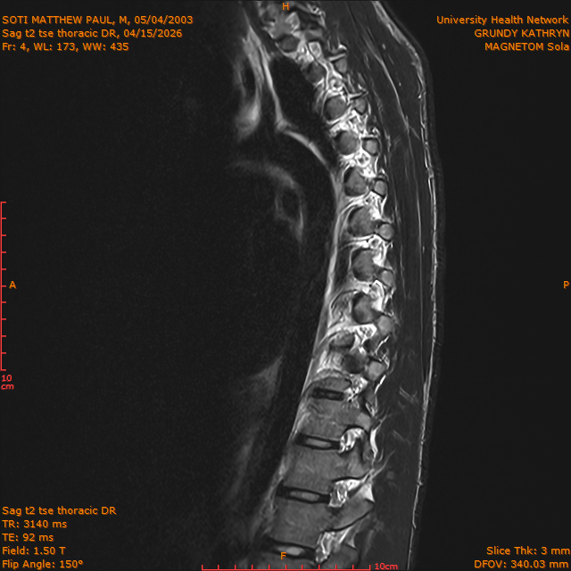 2026-04-15/Entire Spine/Sag t2 tse Thoracic DR/0005-IM308.png
